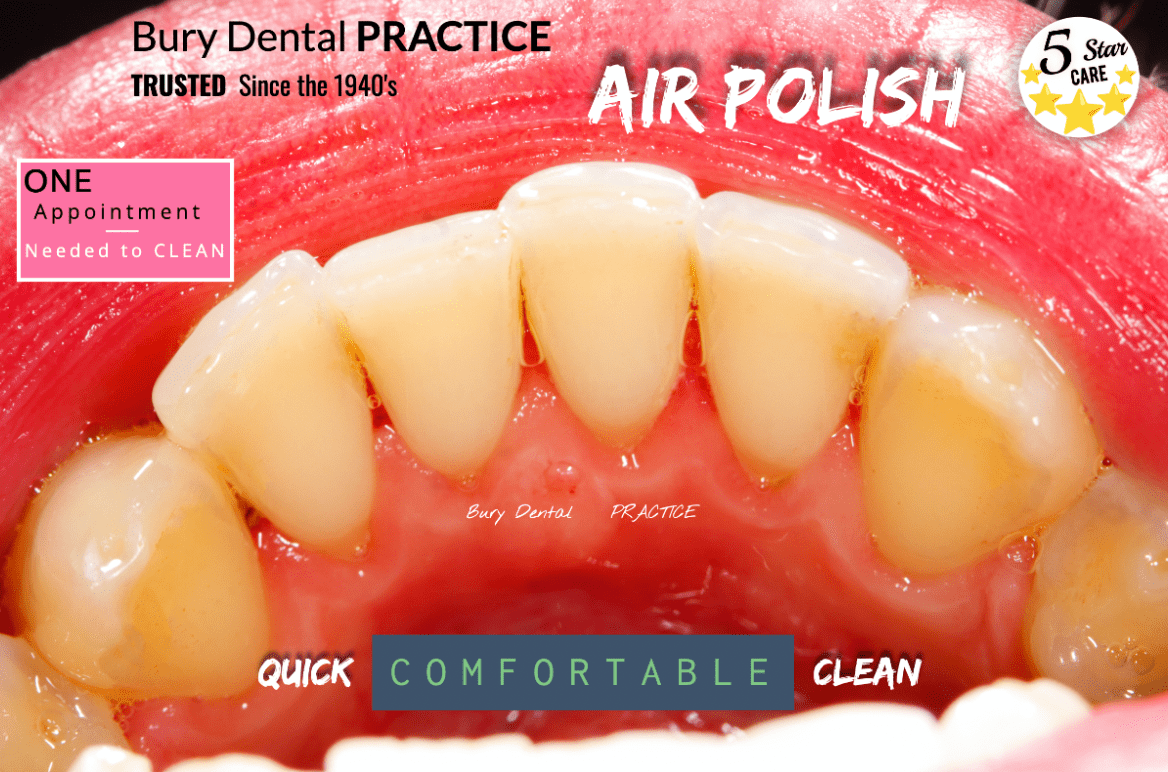 Air Polishing / Stain Removal Bury Dental Practice